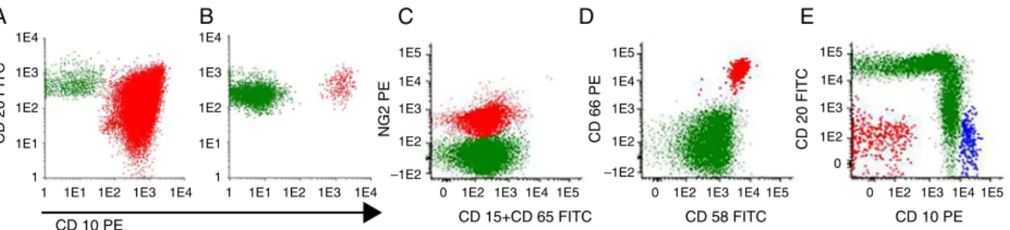 Figure 1 – Minimal residual disease in precursor B-cell acute lymphoblastic leukemia using maturation tube: