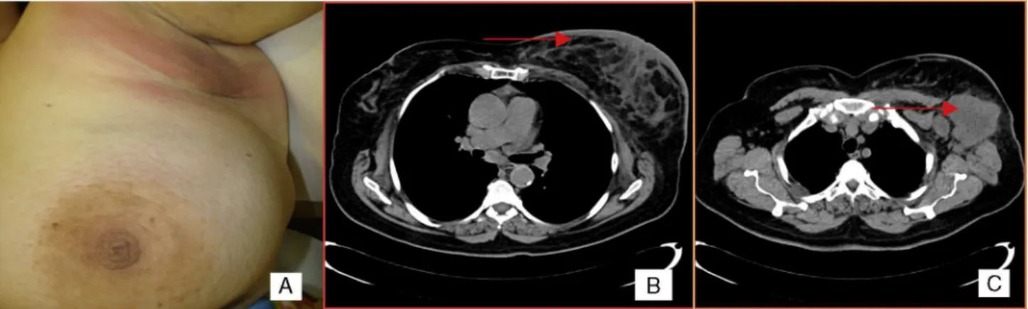 Figure 1 – Clinical features. (A) Erythema and peau d’orange skin edema. (B) Asymmetric skin thickening and stromal edema of the left breast on a computed tomography scan