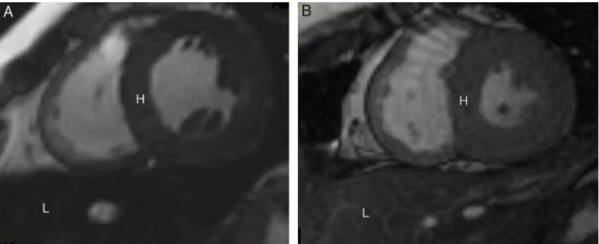 Figure 2 – Cardiovascular magnetic resonance T2* images showing the heart (H) and liver (L) from two different patients at the same echo time (10.70 ms)