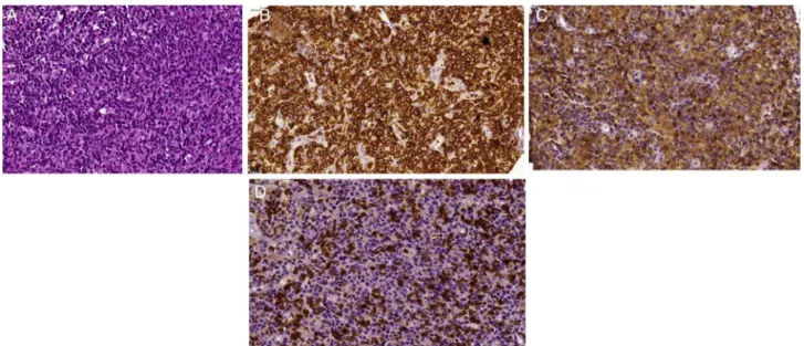 Figure 1 – Morphologic aspects of Peripheral T-cell lymphoma not otherwise specified (PTCL-NOS)