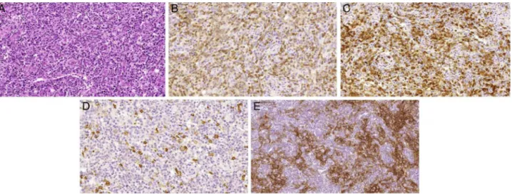 Figure 2 – Morphologic aspects of angioimmunoblastic T-cell lymphoma. (A) Proliferation of small to medium sized lymphoid cells with mild atypia surrounding prominent high endothelial venules