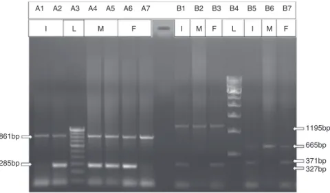 Figure 3 – Agarose gel electrophoresis for the detection of ␤-thalassemia with IVS1-5 (G→C) mutation (ARMS PCR) and Indian deletion-inversion G␥(A␥␦␤) 0 thalassemia (GAP-PCR)