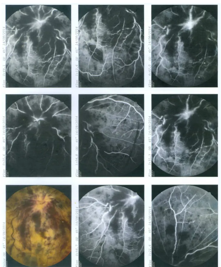 Figure 1 – Fluorescein angiography showing occlusion of central retinal vein.