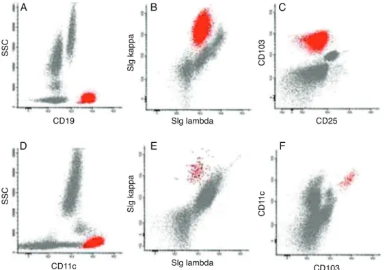 Figure 2 – Representative dot plots of peripheral blood immunophenotyping. (A) Pathological cells (red) CD19 + at diagnosis;