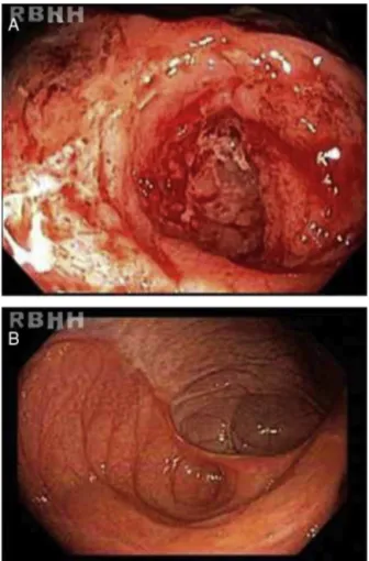 Figure 2 – (A) Ileocolic anastomosis with intense hyperemia, linear ulcers, deformities and spontaneous friability