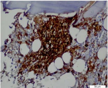Figure 1 – clustered pattern of CD20-positive myeloma cells in bone marrow.