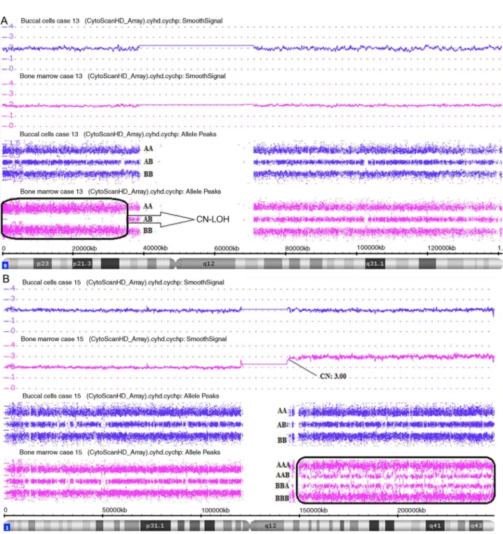 Figure 4 – Affymetrix ® Chromosome Analysis Suite Image. (A) Paired analysis (Buccal cell and bone marrow single nucleotide polymorphism array analysis) of chromosome 9 showing copy-neutral loss of heterozygosity (CN-LOH) only in bone marrow