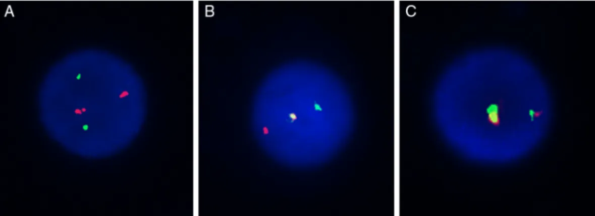 Figure 2 – FISH pattern of MYST3-CREBBP probes. Three types of hybridization patterns were observed: two red and two green signals (A); a single fusion pattern, with one red and one green signal remaining (B); and a dual fusion signal (C).