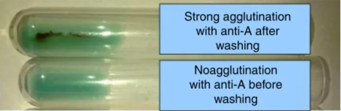 Figure 1 – Unwashed red cells of the patient showed no agglutination with monoclonal anti-A, while after washing three times, red cells showed strong agglutination with anti-A.