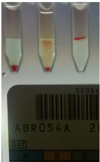 Figure 1 – Results of forward blood grouping by column agglutination technology showing mixed field