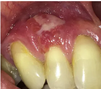 Figure 1 – Swelling of the right anterior maxillary gingiva.