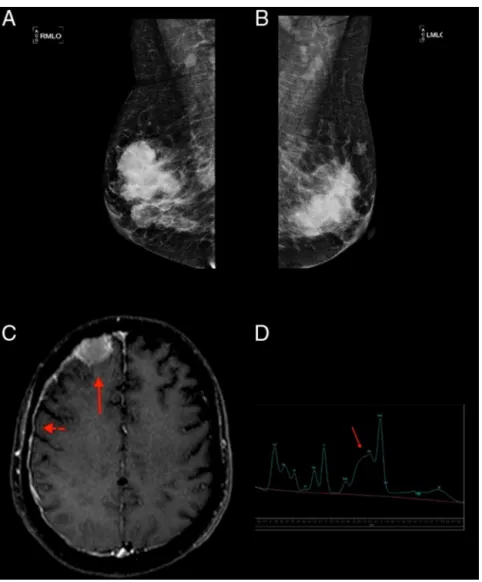 Figure 1 – (A and B) Mammography: hyperdense and lobulated nodules with circumscribed margins; (C) extra-axial expansive lesion compatible with plasmocytoma in the right frontal convexity (arrow) with pachymeningeal impregnation (arrowhead), demonstrating 