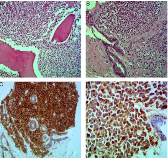 Figure 2 – (A) Breast and (B) bone marrow biopsies, both with hematoxylin and eosin (HE) staining characterized by