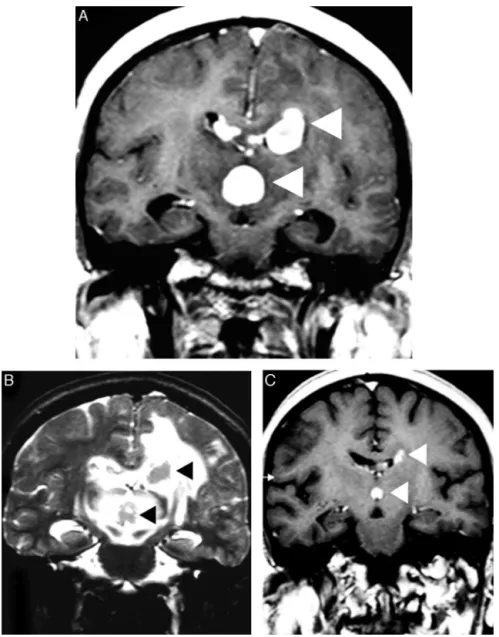 Figure 2 – Corticotherapy effects in a primary central nervous system lymphoma. An axial T1 image after intravenous gadolinium administration (A) shows multifocal primary central nervous system lymphoma as deep homogeneous enhanced masses in the corpus cal
