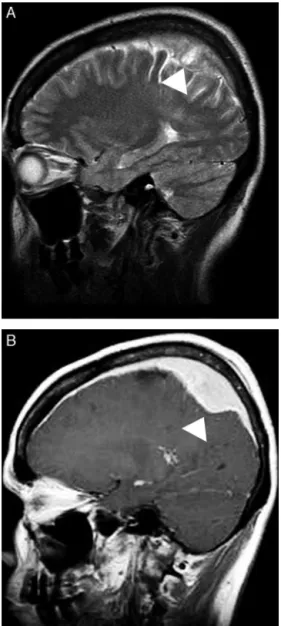 Figure 4 – Mucosa-associated lymphoid tissue (MALT) lymphoma mimicking meningioma. A sagittal T2-weighted image (A) shows a solid extra-axial lesion that infiltrated the dura mater in the parietal region (arrowheads)
