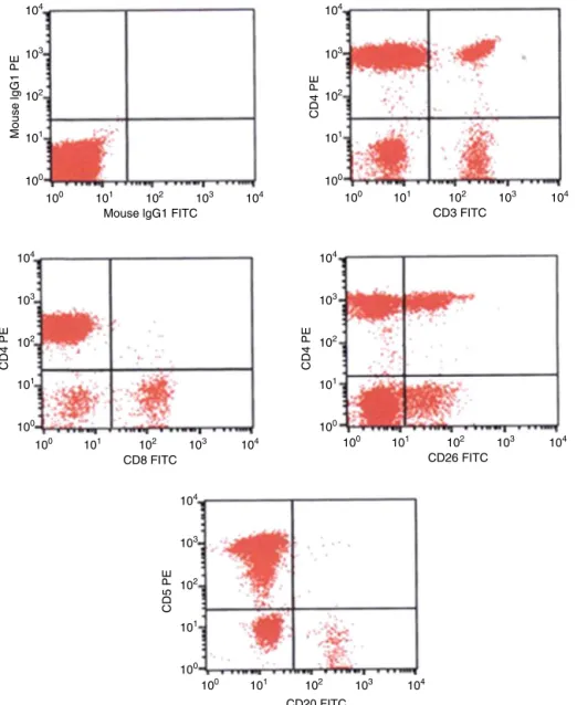 Figure 1 – Immunophenotype by flow cytometry of the peripheral blood showing abnormal T-cells – CD3 − CD5 + , CD4 + , CD26 partial .