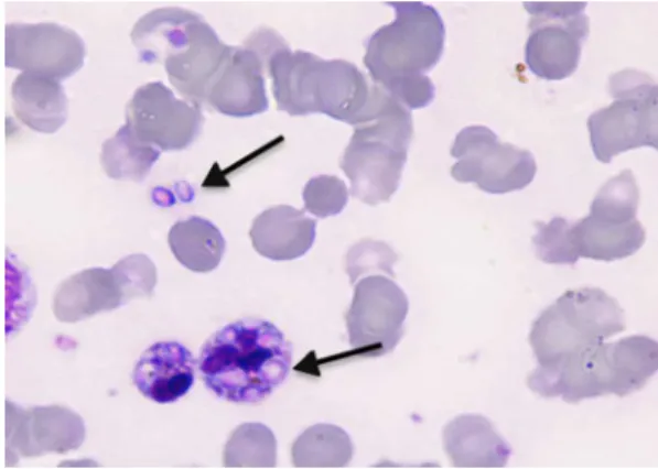 Figure 1 – Arrows show phagocytes containing one or more intracellular Histoplasma capsulatum (magnification: 1000×;