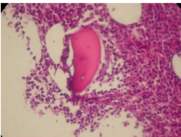 Figure 1 – Hypercellular bone marrow at the expense of plasma cell infiltration (Hematoxylin and eosin stain: