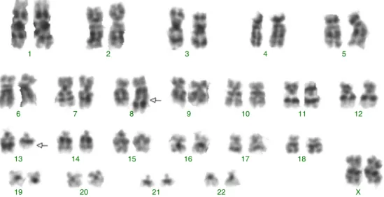 Figure 1 – Abnormal karyotype identified by G-banding with a translocation involving chromosome 8 and 13: