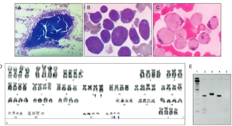 Figure 2 – Bone marrow morphological, cytogenetics and molecular analysis of Case 2. (A) Hypercellular bone marrow fragment