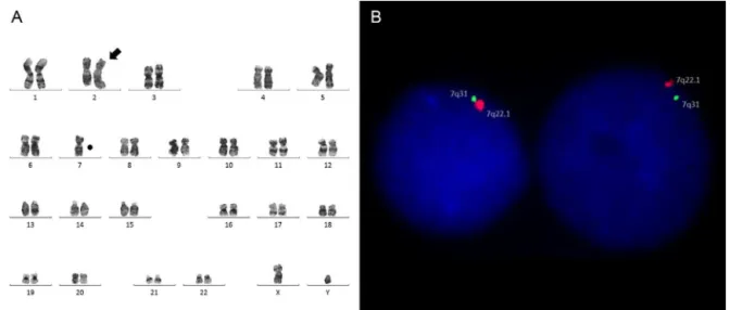 Figure 1 – (A) Karyotype (G-band): 45,XY,add(2)(q35),-7[20]. (B) FISH (Del (7q) Deletion Probe, ref: RU-LPH 025; Cytocell, Cambridge, UK): Deletion of RELN gene (chromosome 7) in 96% of the analyzed nuclei