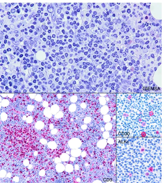 Figure 2 – Histologic section from the bone marrow biopsy sample showing mild nodular and interstitial infiltration by small lymphocytes (Giemsa: 200×)