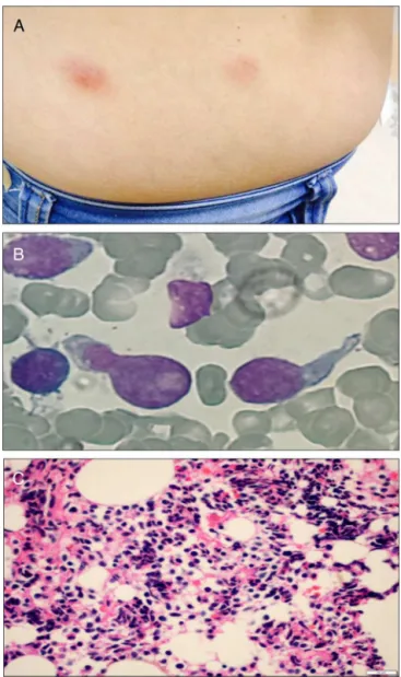 Figure 1 – Physical and morphologic features of blastic plasmacytoid dendritic cell neoplasm