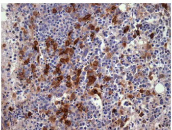Figure 4 – Bone marrow biopsy of patient with secondary myeloid neoplasm showing cluster CD117+ cells
