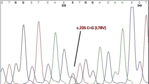 Figure 2 – Sequence analysis of the case identified in the study showing the heterozygosity for Hb Ullevaal (␤78(EF2) Leu&gt;Val; HBB: c.235 C&gt;G).