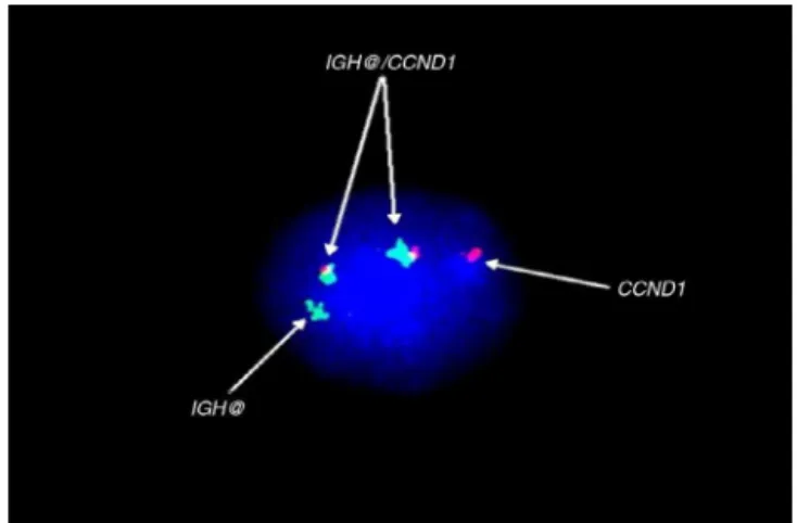 Figure 3 – FISH using probes for the CCND1 gene (red) and IGH gene (green), and red and green fusion, corresponding to IGH-CCND1 rearrangement.