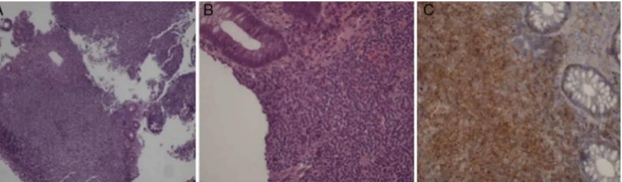 Figure 2 – Histopathological features of the lymphoma. (A, B) Diffuse intestinal mural infiltration of tumor cells (A –