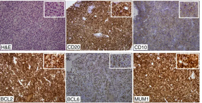 Figure 1 – The tumor cells are positive for CD20, CD10, BCL2, BCL6 and MUM1. Original magnification images 200×.