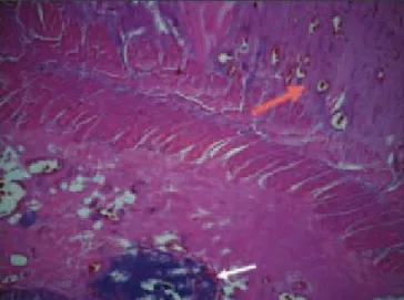 Figure 1. Bowel mucosa and smooth muscle cells (white arrow) adjacent  to whirled smooth muscle cell typical of uterine ibroids (red arrow).