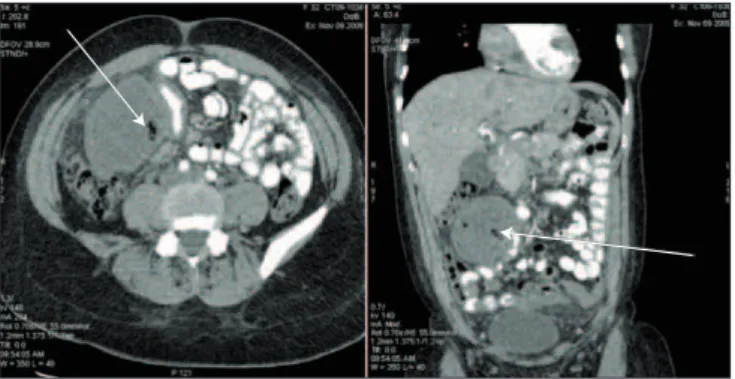 Figure 3. Parasitic ibroid (red arrow) intimately related to the mesenteric  border of the right colon/hepatic lexure.