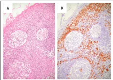 Figure 3. Intraparenchymatous involvement of sentinel lymph node. (A)   Hematoxilin-eosin – original magniication 100X; (B) Same area  high-lighted by immunodetection of cytokeratins AE1/AE3.