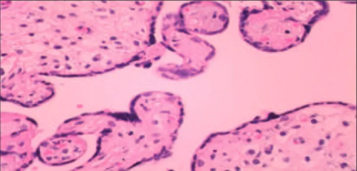 Figure 2. In a higher magniication of a histological section of irst trimes- trimes-ter’s villi with hydropic stroma numerous Hofbauer cells are observed  (HE ×400)
