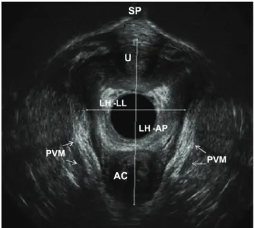 Figure 1. 3-D endovaginal ultrasound with 2052 endoprobe. Measure- Measure-ments of levator hiatus dimensions, including the anteroposterior and  latero-lateral diameter in axial plane