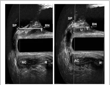 Figure 4. 3-D endovaginal ultrasound with 2052 endoprobe. Measure- Measure-ments of bladder neck position in mid-saggital plane