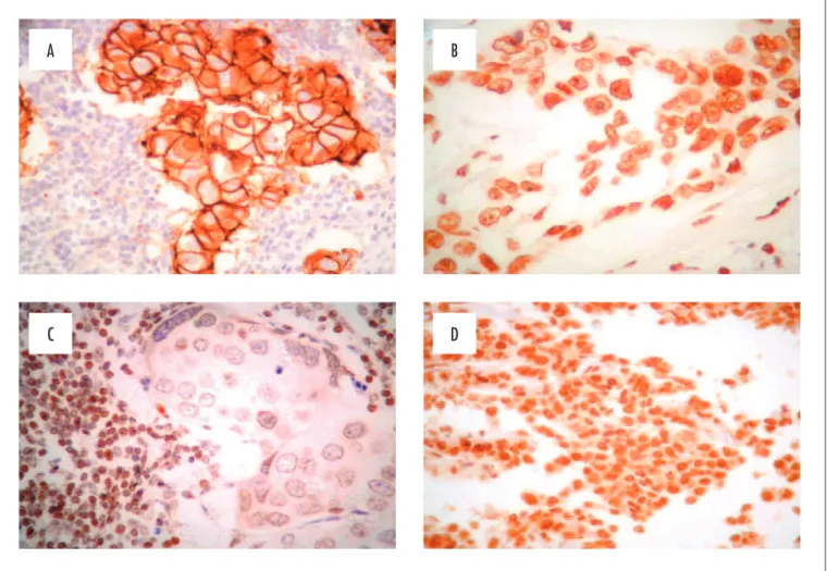 Figure 1. (A) HER2 positive carcinoma with complete and strong membrane expression of the protein in more than 30% of cells; (B) PTEN present  characterized by nuclear expression in 100% of neoplastic cells; (C) PTEN reduced characterized by negative react