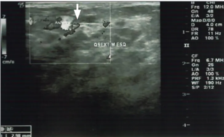 Figure 1. Left breast with a lump in the upper outer quadrant.