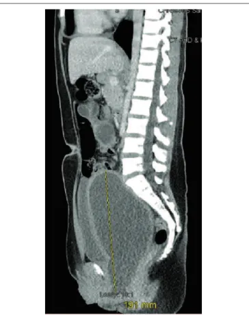 Figure 2. Coronal computed tomography scan of abdomen and pelvis  demonstrating absence of the left kidney and enlarged uterus  compat-ible with hematocolpos.