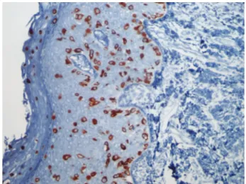 Fig. 4 Immunohistochemistry of vulvar biopsy for Cytokeratin 7.