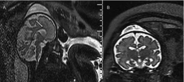 Fig. 2 T2-weighted MRI performed in a fetus at 28.4 weeks of gestation: brachycephaly (A), subcuticular frontal edema (B) and hypertelorism (C) were detected.