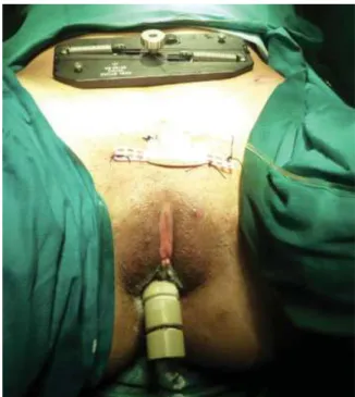Fig. 4 Final internal aspect: Tension threads attached to vaginal dummy coursing subperitoneally.