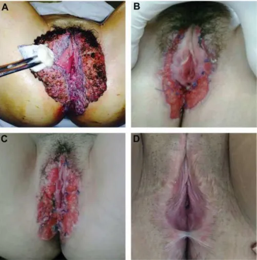 Fig. 3 Chromogenic in situ hybridization (CISH); A: high risk HPV (negative CISH, 400X); B: low risk HPV (positive CISH, 400X).