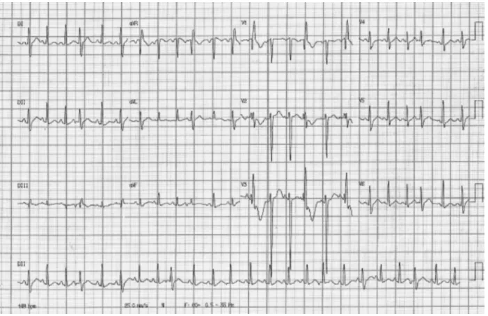 Fig. 2 Anteroposterior chest X-rays showing slight increase in cardiothoracic ratio.