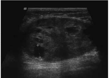 Fig. 3 Third illustrative example of a mass in this study. There were several cystic foci that alone or combined did not occupy more than half of the mass