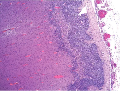 Fig. 5 (A) Histopathological ﬁ ndings – neurons of germinal matrix with some viral inclusions (arrow), with the typical aspect of cytomegalic cells (HE)