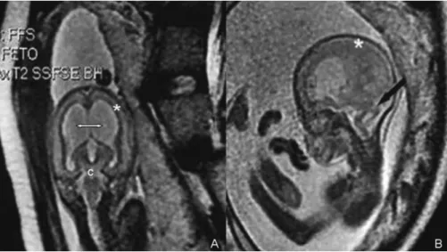 Fig. 3 (A) Histology shows the typical cobblestone pattern of the cerebral cortex in lissencephaly type 2