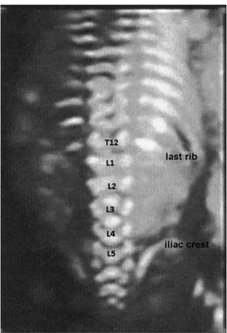 Fig. 1 Two-dimensional evaluation showing points of reference for assessing the injury level in the cases of spina bi ﬁ da, in which the last rib is considered as the level of the 12th thoracic vertebra (T12) and the iliac crest is considered as the level 